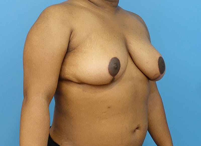 Breast Reduction Before & After Gallery - Patient 112344708 - Image 8