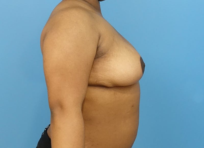 Breast Reduction Before & After Gallery - Patient 112344708 - Image 10