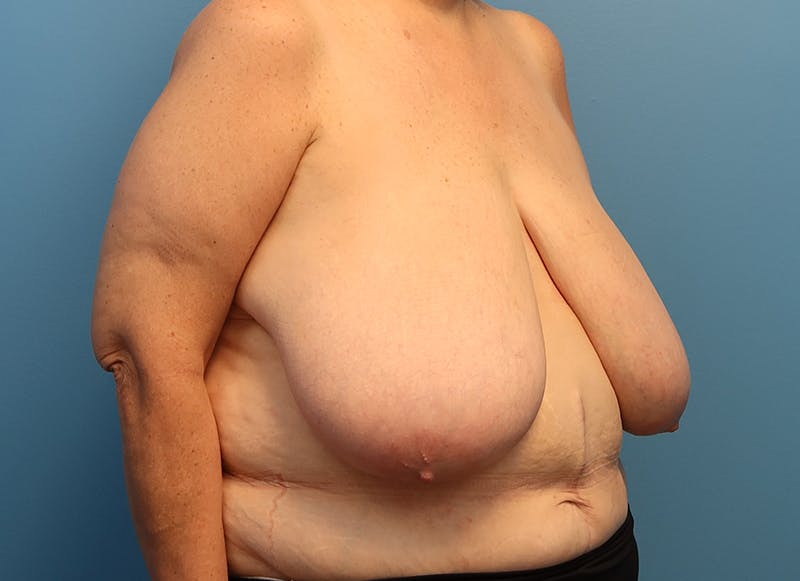 Breast Reduction Before & After Gallery - Patient 112344712 - Image 7
