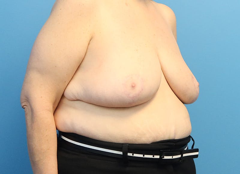 Breast Reduction Before & After Gallery - Patient 112344712 - Image 8