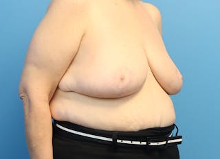 Breast Reduction Before & After Gallery - Patient 112344712 - Image 8