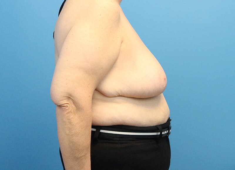 Breast Reduction Before & After Gallery - Patient 112344712 - Image 10