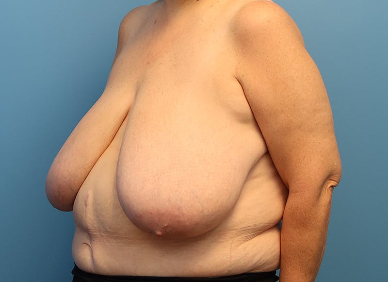 Breast Reduction Before & After Gallery - Patient 112344712 - Image 3