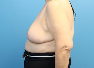 Breast Reduction Before & After Gallery - Patient 112344712 - Image 2