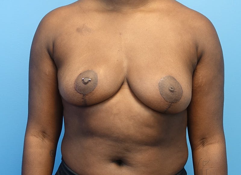 Breast Reduction Before & After Gallery - Patient 112344716 - Image 6