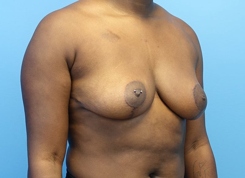 Breast Reduction Before & After Gallery - Patient 112344716 - Image 8