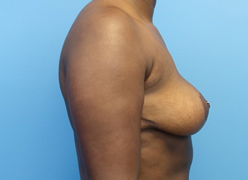 Breast Reduction Before & After Gallery - Patient 112344716 - Image 10
