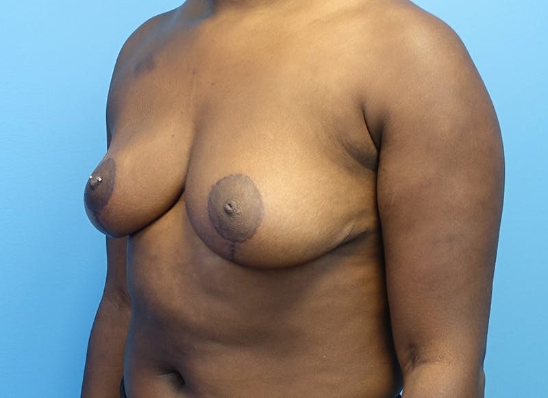 Breast Reduction Before & After Gallery - Patient 112344716 - Image 4