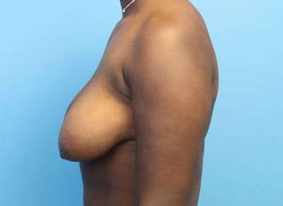 Breast Reduction Before & After Gallery - Patient 112344716 - Image 1