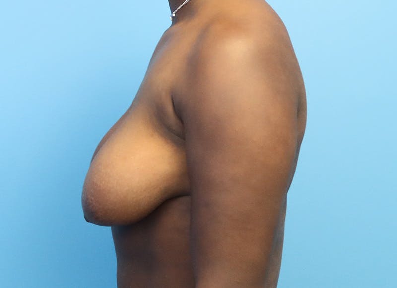 Breast Reduction Before & After Gallery - Patient 112344716 - Image 1