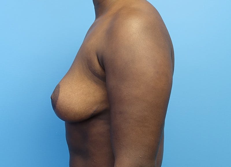 Breast Reduction Before & After Gallery - Patient 112344716 - Image 2