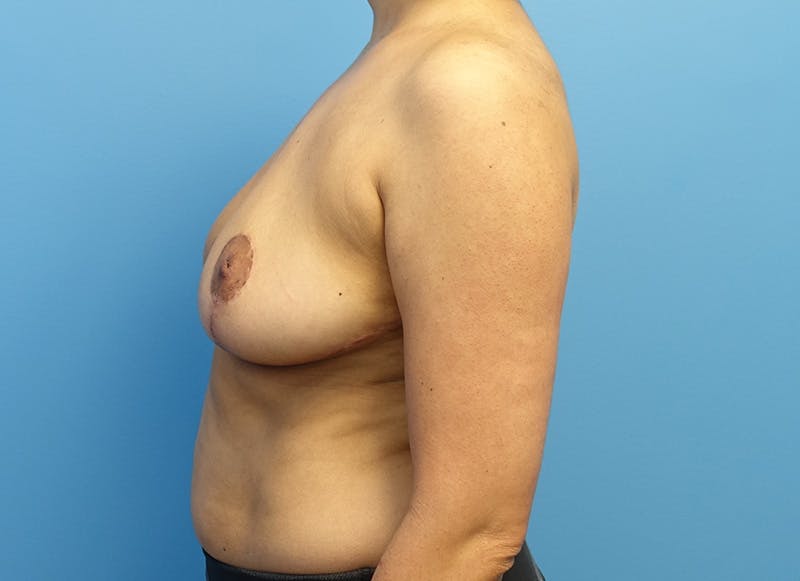 Breast Reduction Before & After Gallery - Patient 112344718 - Image 2