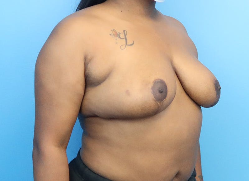 Breast Reduction Before & After Gallery - Patient 112344726 - Image 8