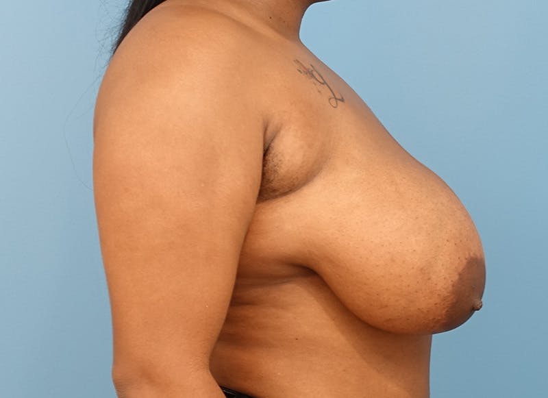 Breast Reduction Before & After Gallery - Patient 112344726 - Image 9