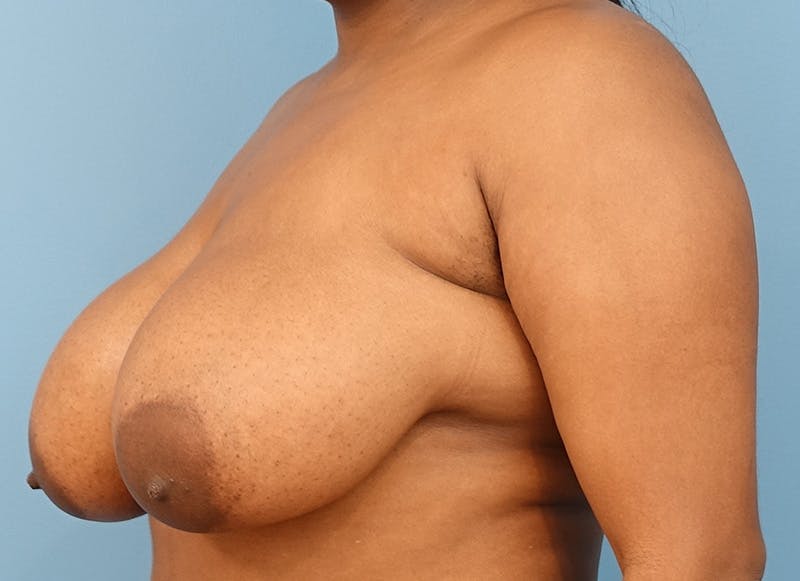 Breast Reduction Before & After Gallery - Patient 112344726 - Image 3