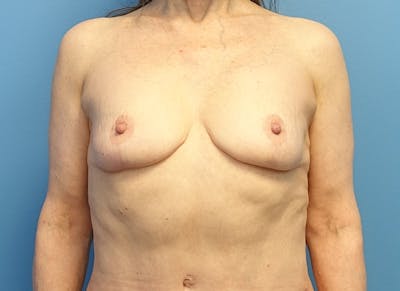 Breast Reduction Before & After Gallery - Patient 112344727 - Image 6