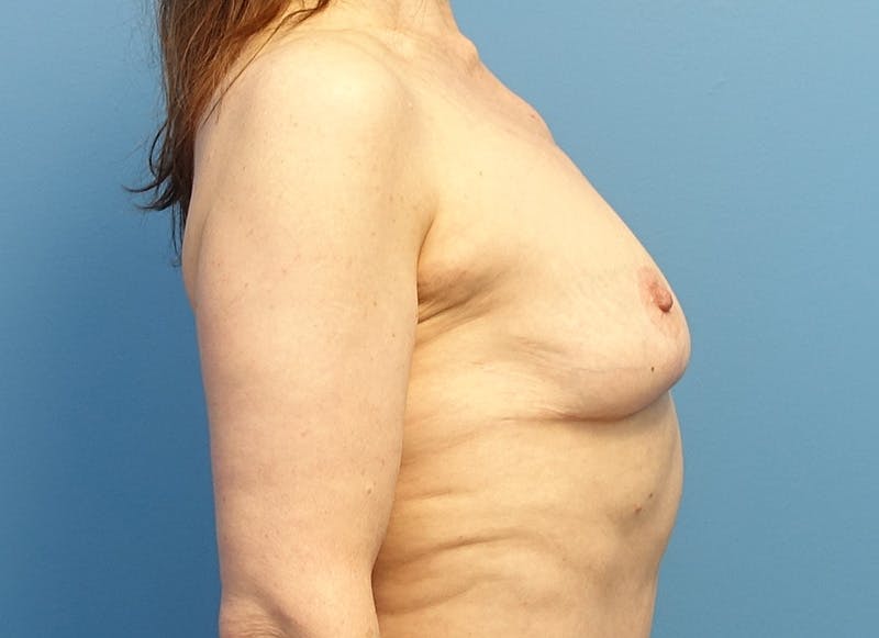 Breast Reduction Before & After Gallery - Patient 112344727 - Image 10