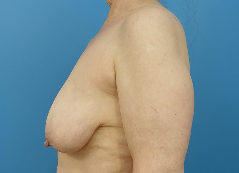 Breast Reduction Before & After Gallery - Patient 112344727 - Image 1