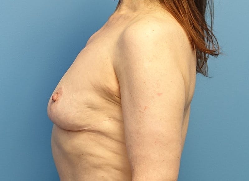 Breast Reduction Before & After Gallery - Patient 112344727 - Image 2