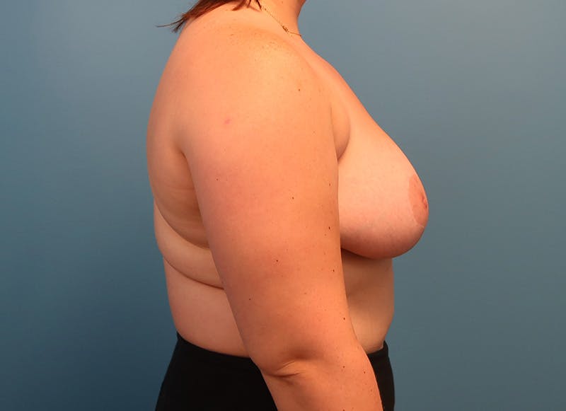 Breast Reduction Before & After Gallery - Patient 112344728 - Image 10