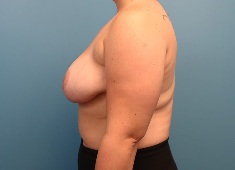 Breast Reduction Before & After Gallery - Patient 112344728 - Image 2