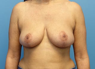 Breast Reduction Before & After Gallery - Patient 112344731 - Image 6
