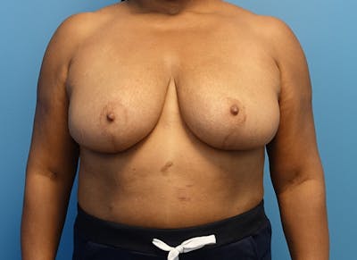 Breast Reduction Before & After Gallery - Patient 112344733 - Image 6