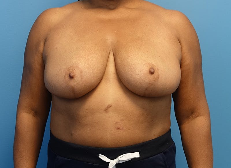 Breast Reduction Before & After Gallery - Patient 112344733 - Image 6