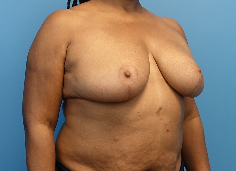 Breast Reduction Before & After Gallery - Patient 112344733 - Image 8
