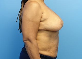 Breast Reduction Before & After Gallery - Patient 112344733 - Image 10