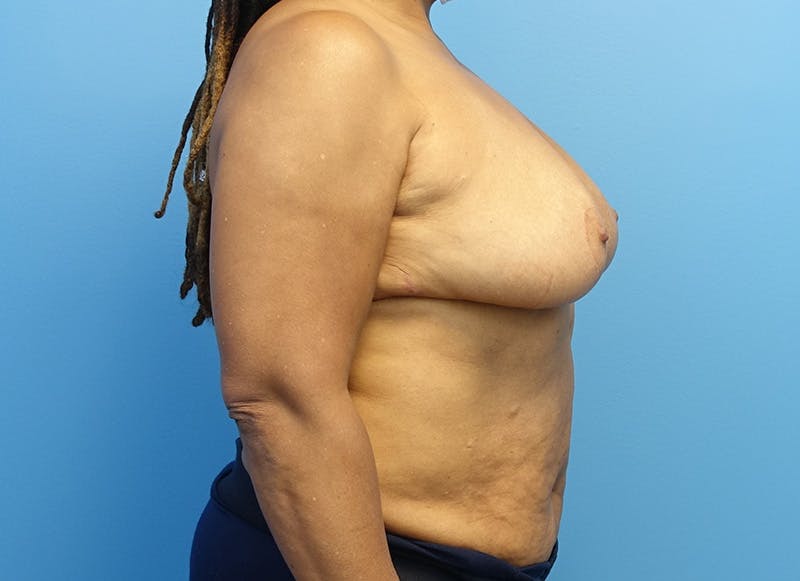 Breast Reduction Before & After Gallery - Patient 112344733 - Image 10