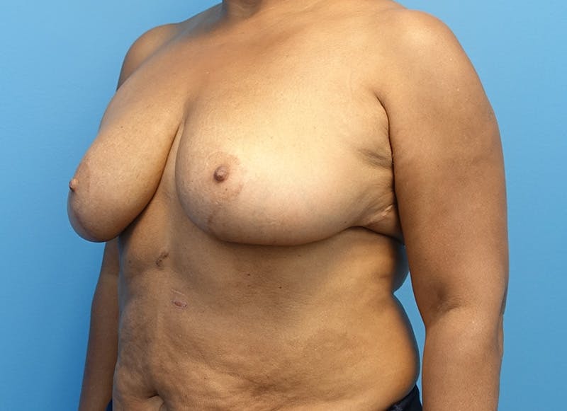 Breast Reduction Before & After Gallery - Patient 112344733 - Image 4
