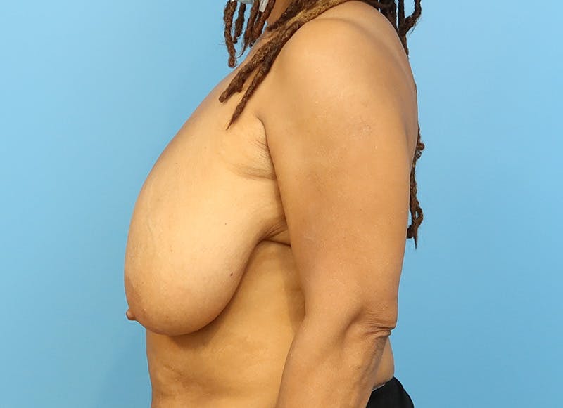 Breast Reduction Before & After Gallery - Patient 112344733 - Image 1