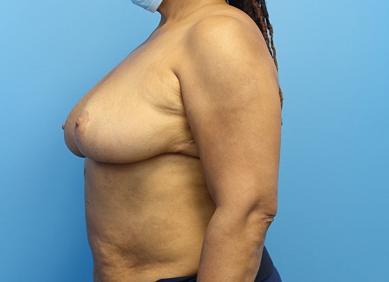 Breast Reduction Before & After Gallery - Patient 112344733 - Image 2