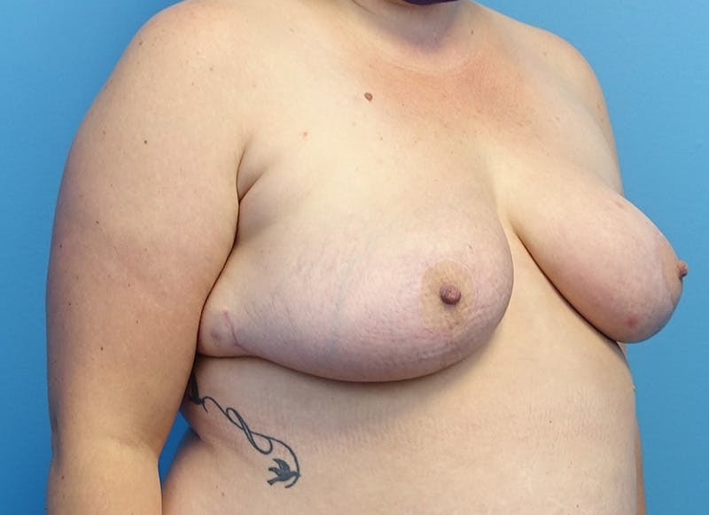 Breast Reduction Before & After Gallery - Patient 112344734 - Image 8