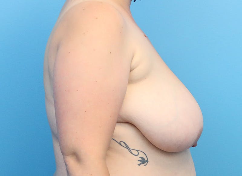 Breast Reduction Before & After Gallery - Patient 112344734 - Image 9
