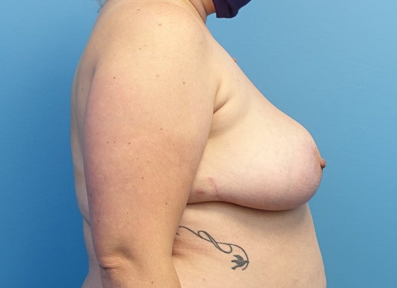 Breast Reduction Before & After Gallery - Patient 112344734 - Image 10