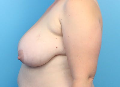 Breast Reduction Before & After Gallery - Patient 112344734 - Image 1