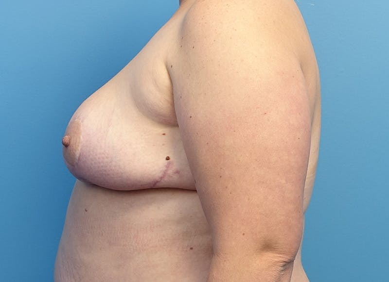 Breast Reduction Before & After Gallery - Patient 112344734 - Image 2