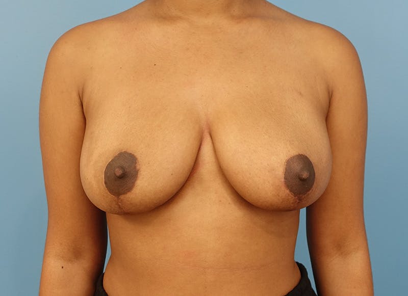 Breast Reduction Before & After Gallery - Patient 112344735 - Image 6