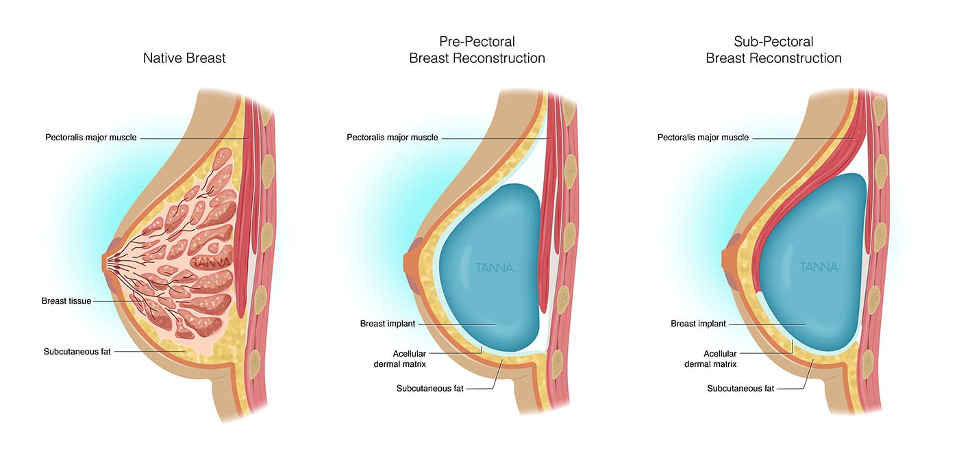 Breast Reconstruction Long Island