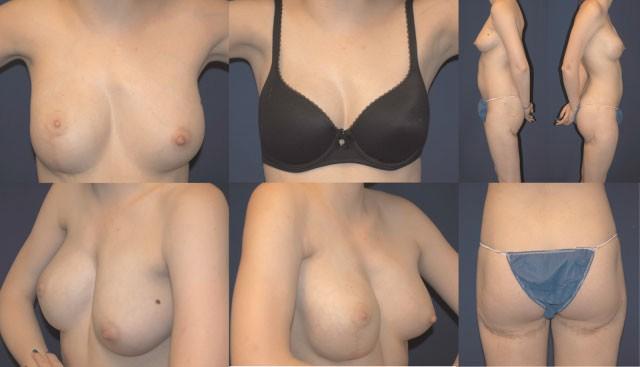 breast reconstruction and donor sites