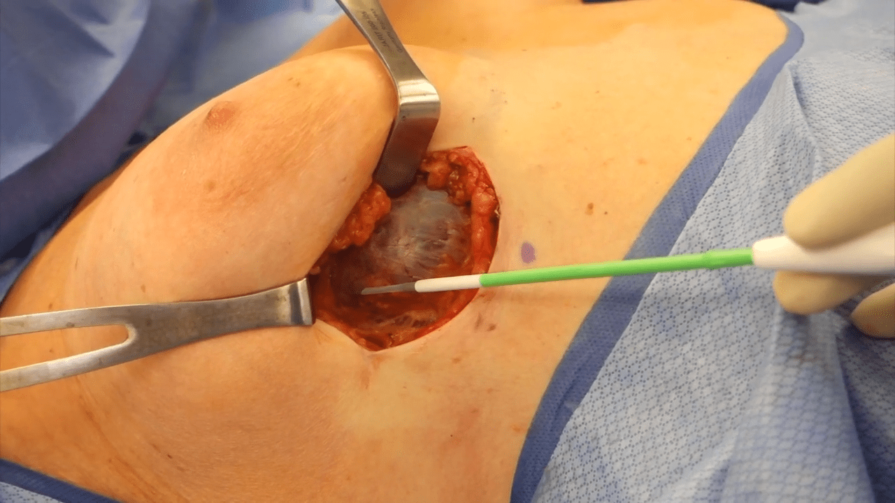 capsulotomy