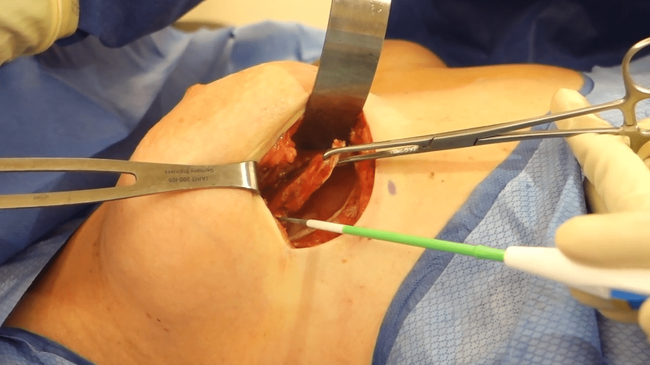 partial capsulectomy