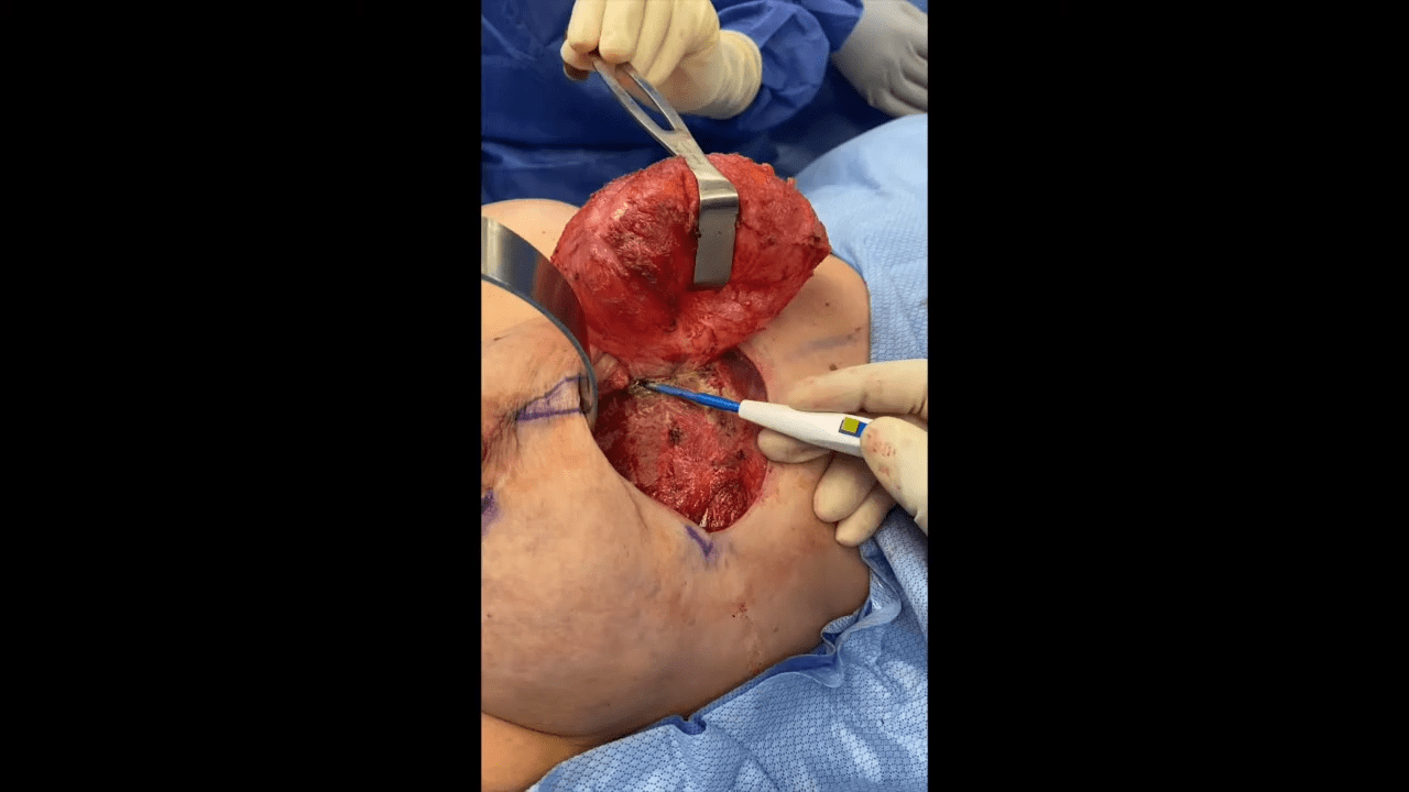 total capsulectomy