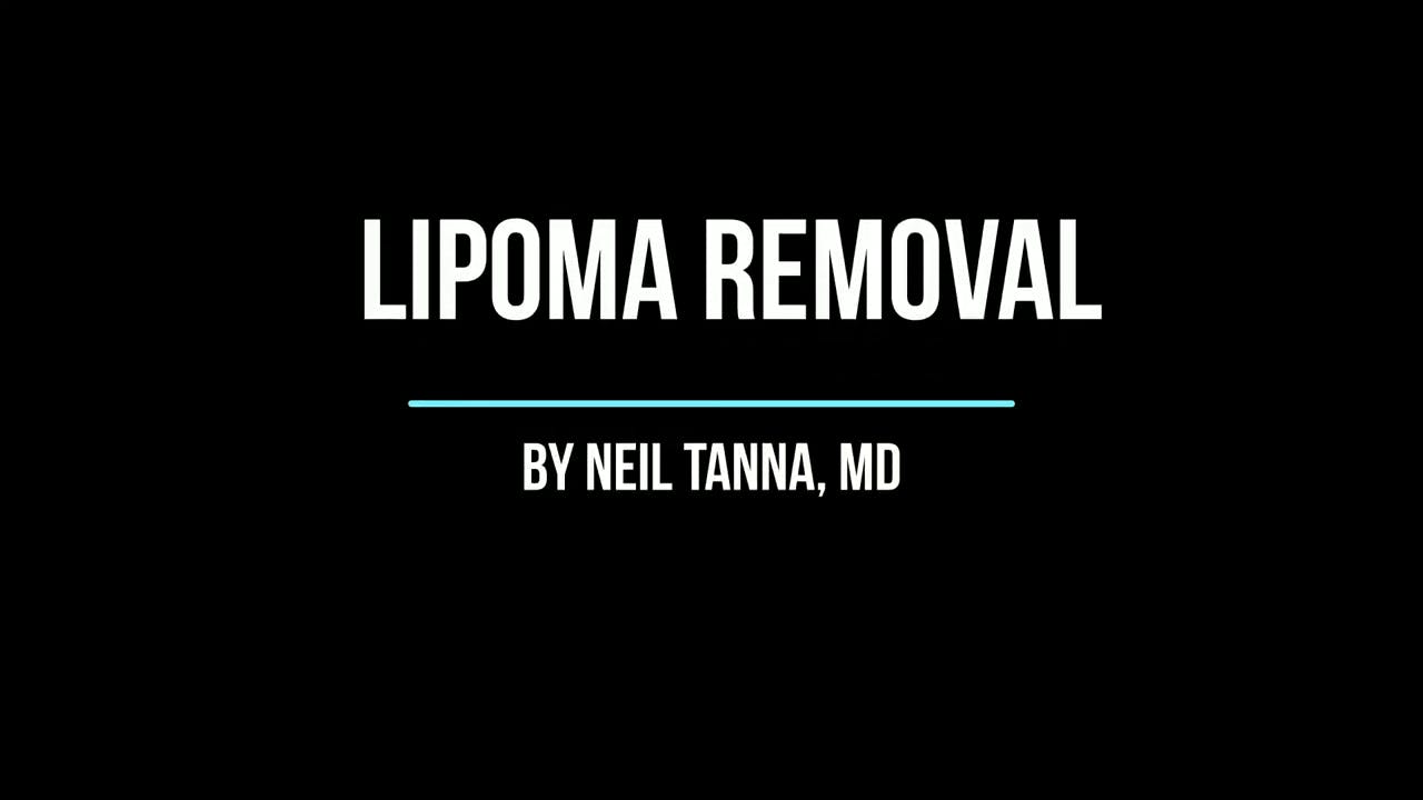 Lipoma Removal Sign