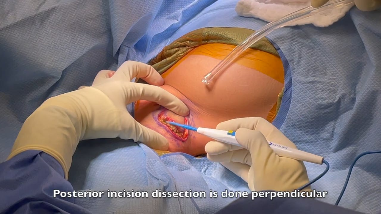 Image of a Procedure Incision