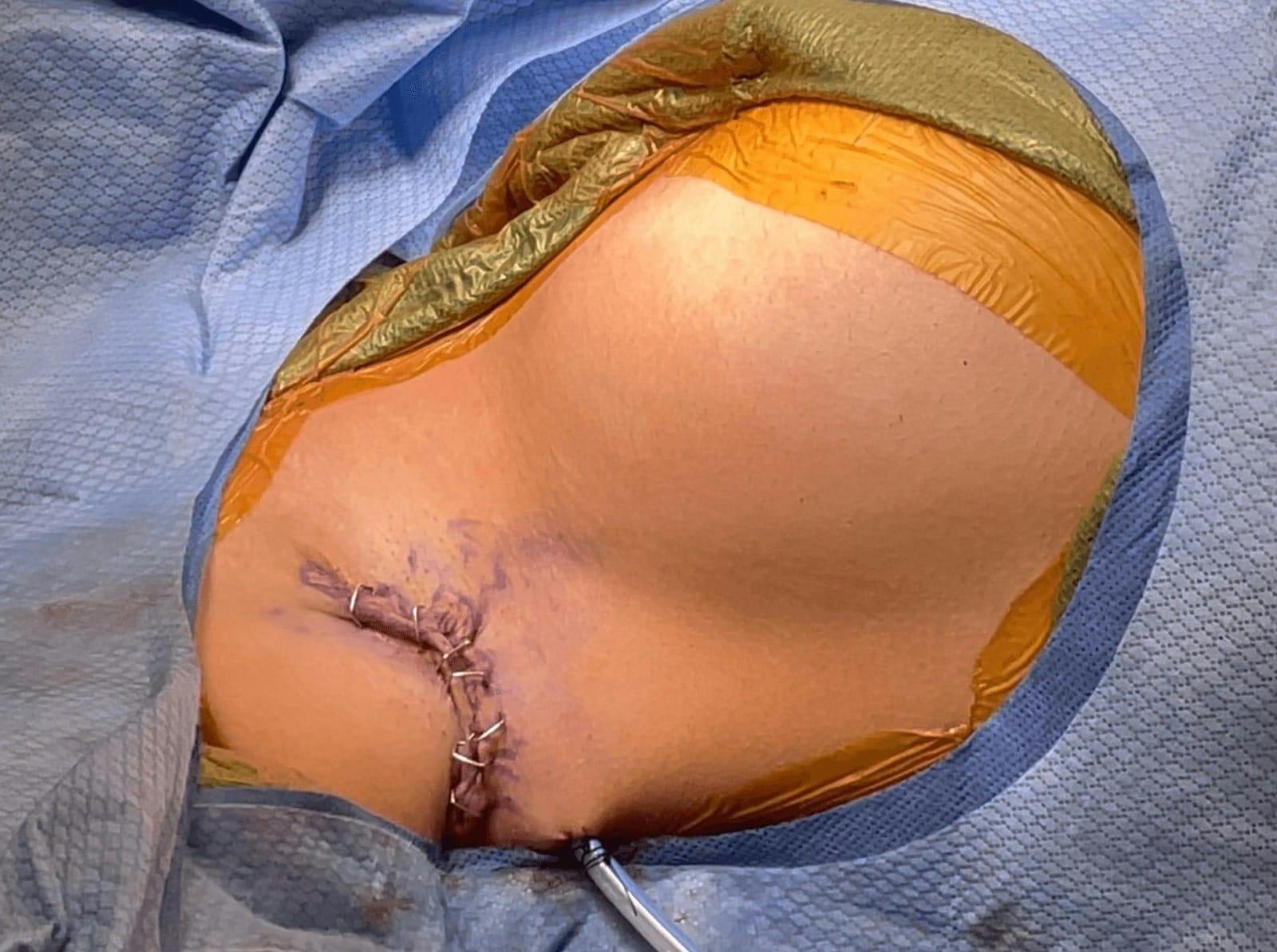 Breast Incision