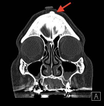 Front of a Skull