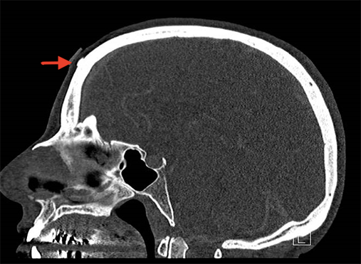 Side of a Skull